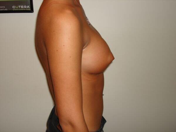 Breast Augmentation Before & After Image