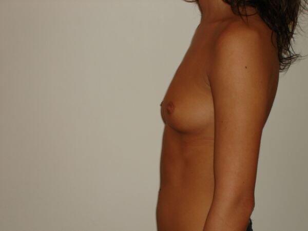 Breast Augmentation Before & After Image