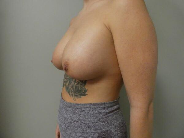 Breast Augmentation Before & After Image