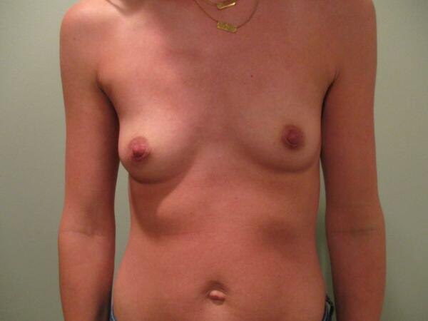 Breast Augmentation Before & After Image