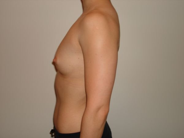 Breast Augmentation Before & After Image