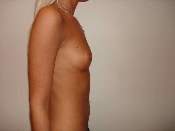 Breast Augmentation Before & After Image