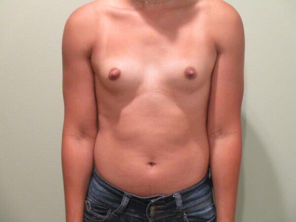 Breast Augmentation Before & After Image