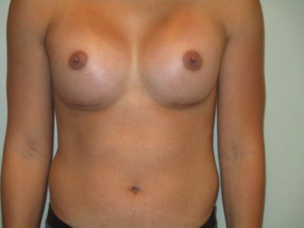 Breast Augmentation Before & After Image