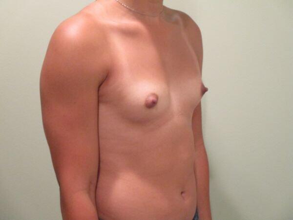 Breast Augmentation Before & After Image