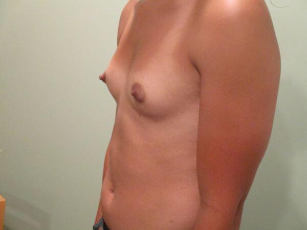 Breast Augmentation Before & After Image