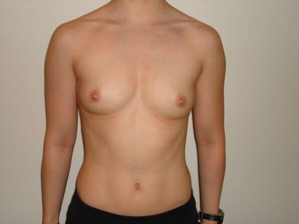 Breast Augmentation Before & After Image