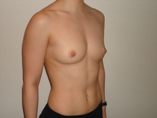 Breast Augmentation Before & After Image