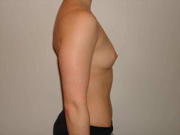 Breast Augmentation Before & After Image