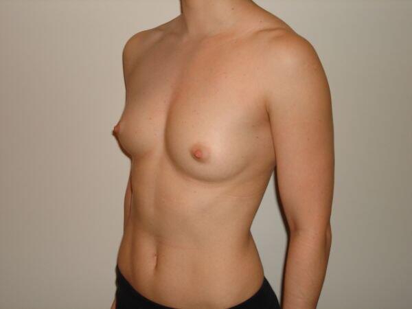 Breast Augmentation Before & After Image