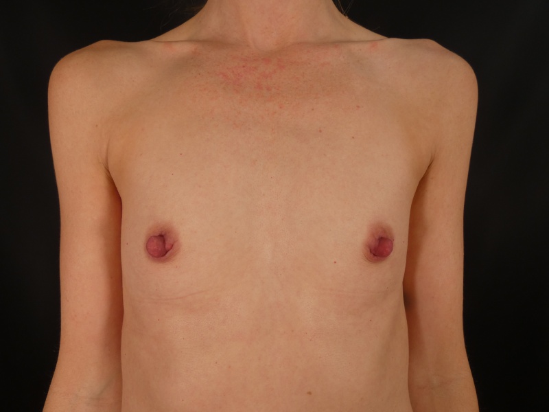 Breast Augmentation Before & After Image