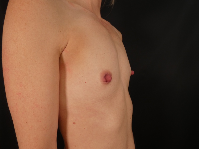 Breast Augmentation Before & After Image