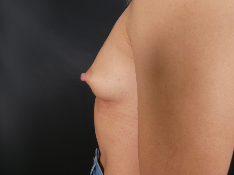 Breast Augmentation Before & After Image