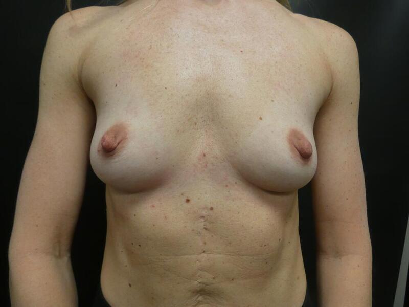 Breast Augmentation Before & After Image