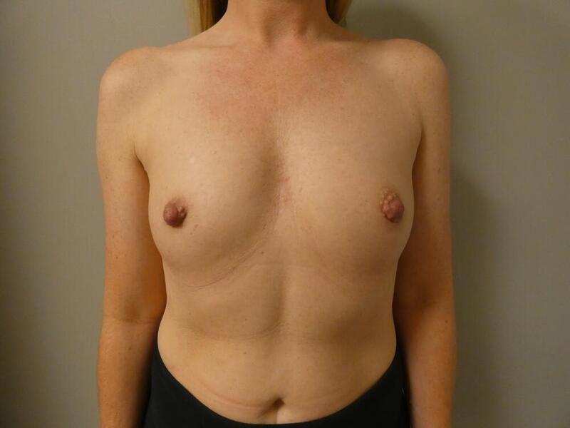 Breast Augmentation Before & After Image