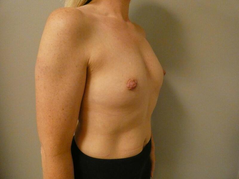 Breast Augmentation Before & After Image