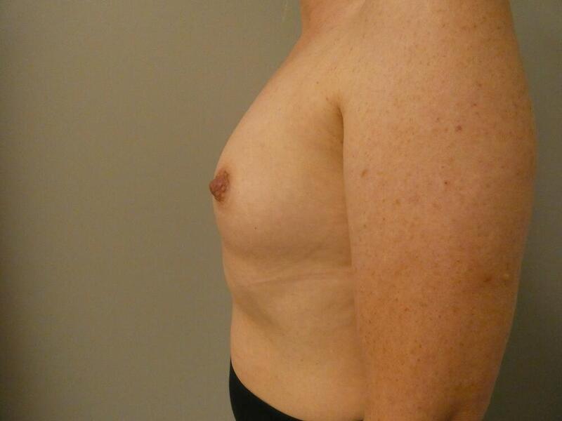 Breast Augmentation Before & After Image