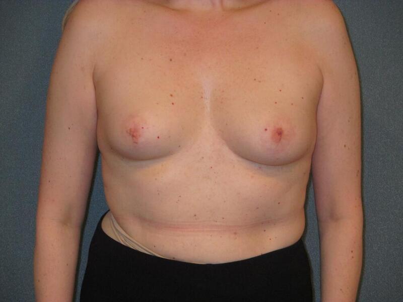 Breast Augmentation Before & After Image