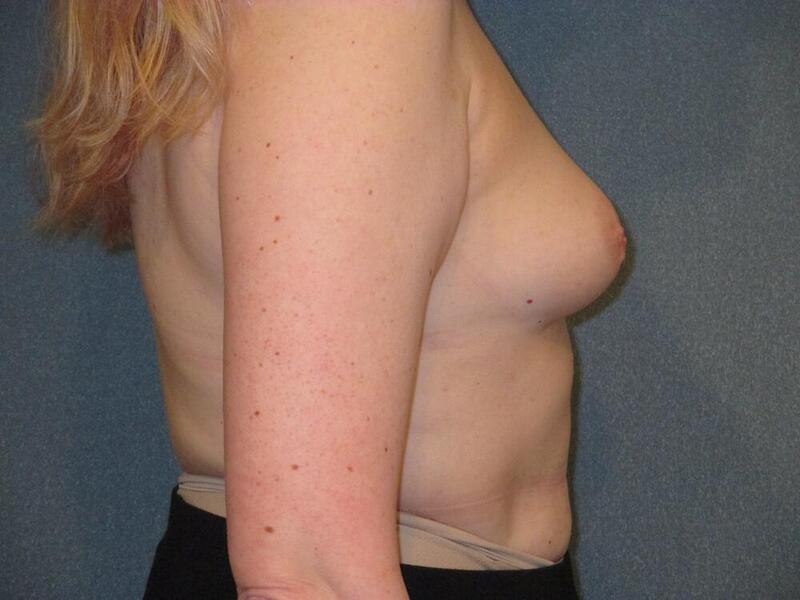 Breast Augmentation Before & After Image