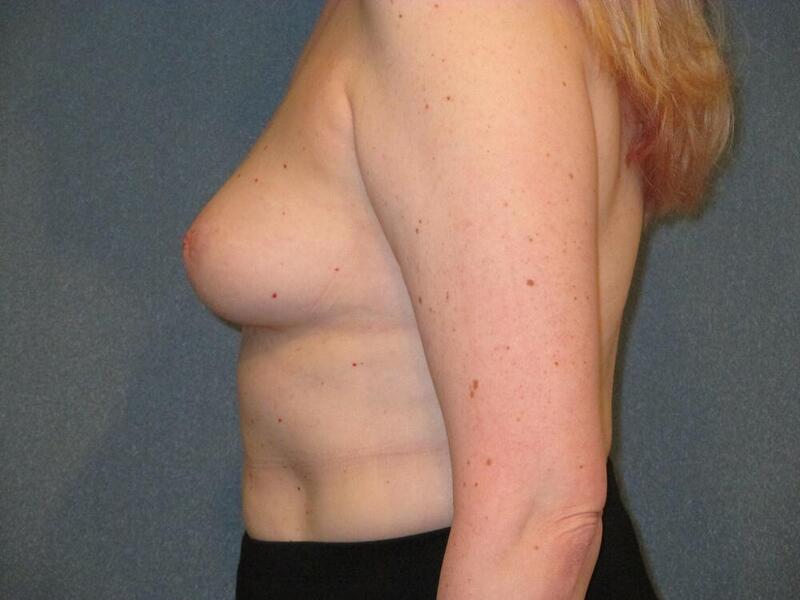 Breast Augmentation Before & After Image