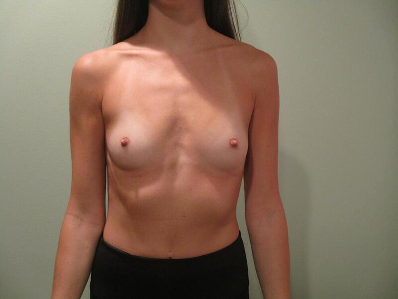 Breast Augmentation Before & After Image