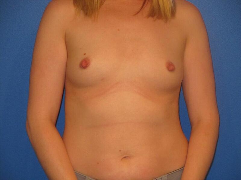 Breast Augmentation Before & After Image