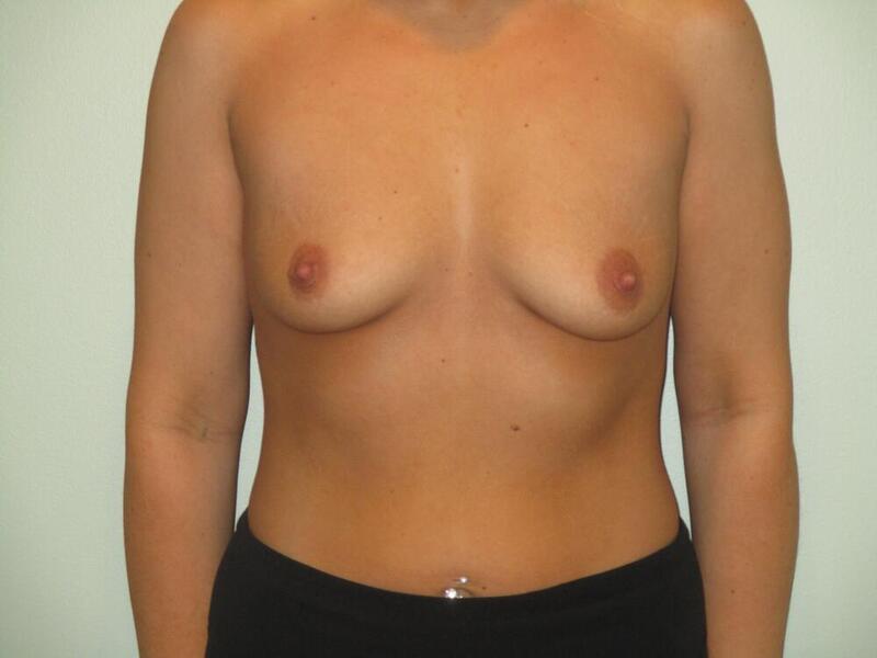 Breast Augmentation Before & After Image