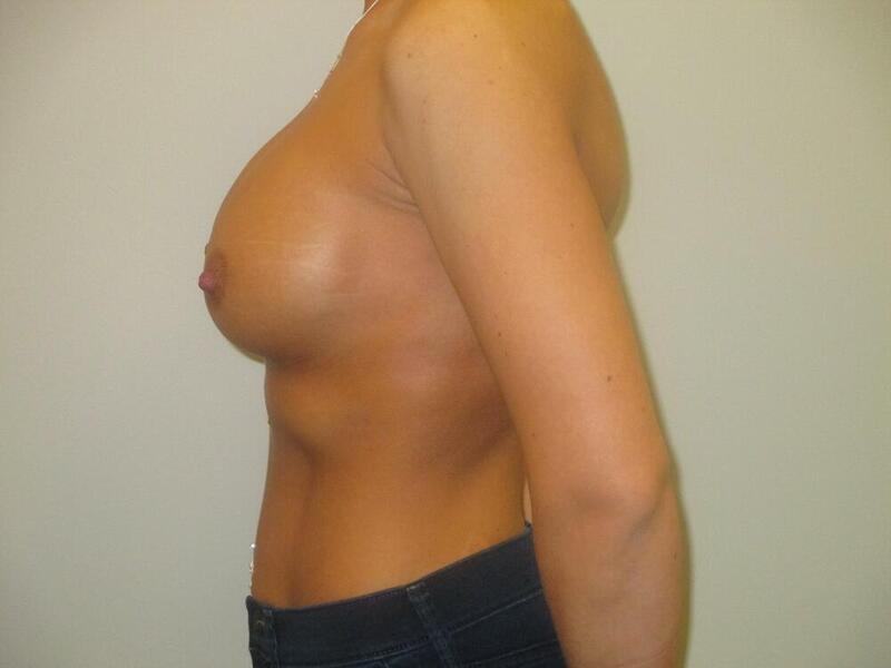 Breast Augmentation Before & After Image