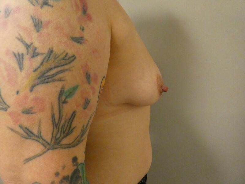 Breast Augmentation Before & After Image