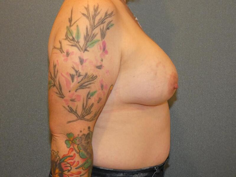 Breast Augmentation Before & After Image