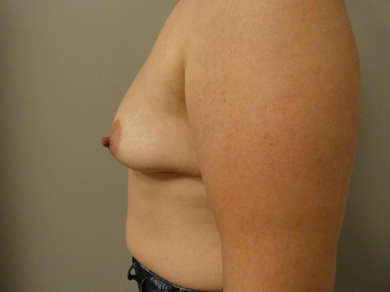 Breast Augmentation Before & After Image