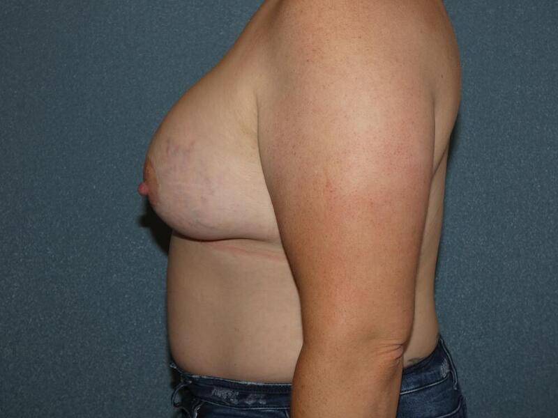 Breast Augmentation Before & After Image