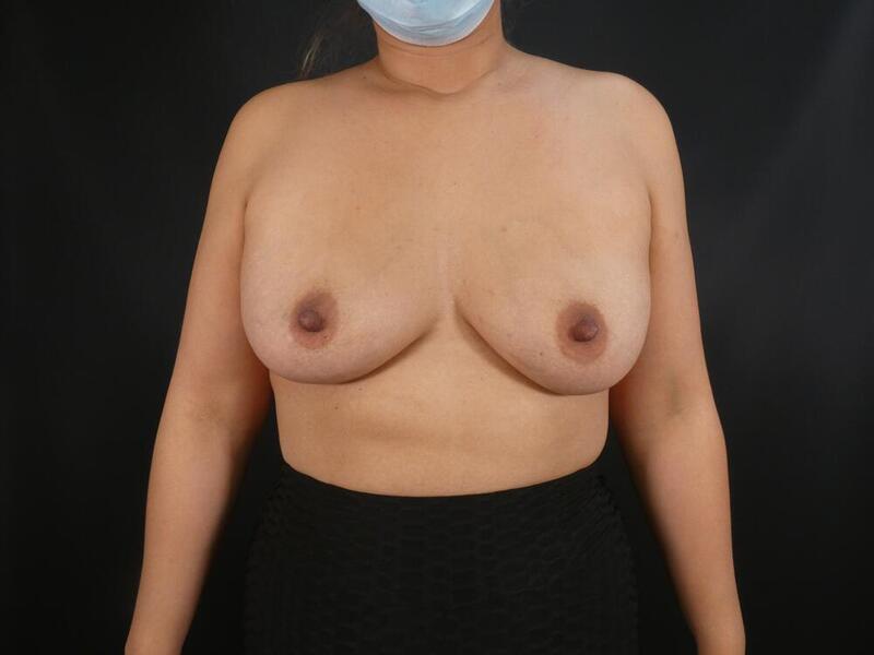 Breast Augmentation Before & After Image