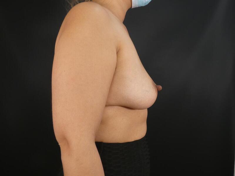 Breast Augmentation Before & After Image