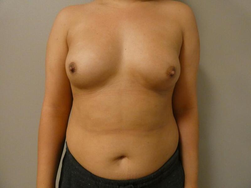 Breast Augmentation Before & After Image