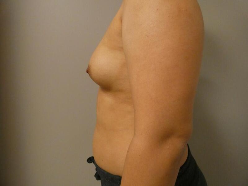 Breast Augmentation Before & After Image