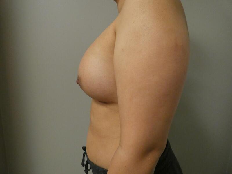 Breast Augmentation Before & After Image