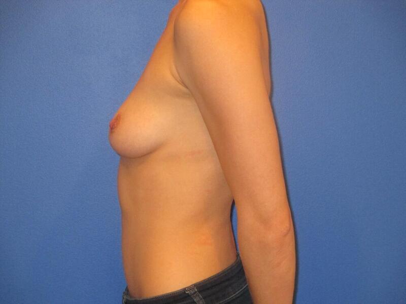 Breast Augmentation Before & After Image