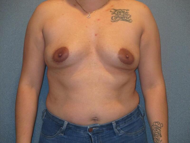 Breast Augmentation Before & After Image