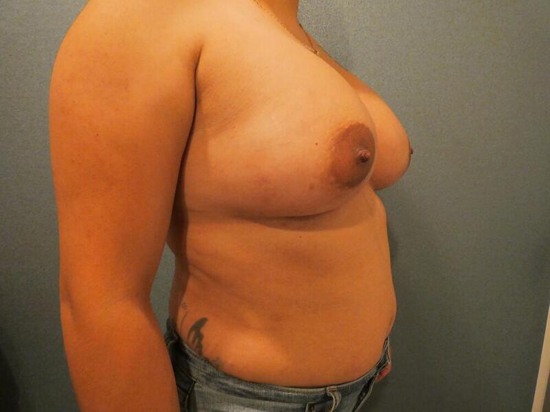 Breast Augmentation Before & After Image