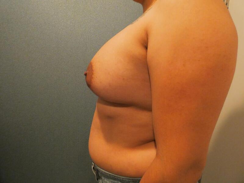 Breast Augmentation Before & After Image