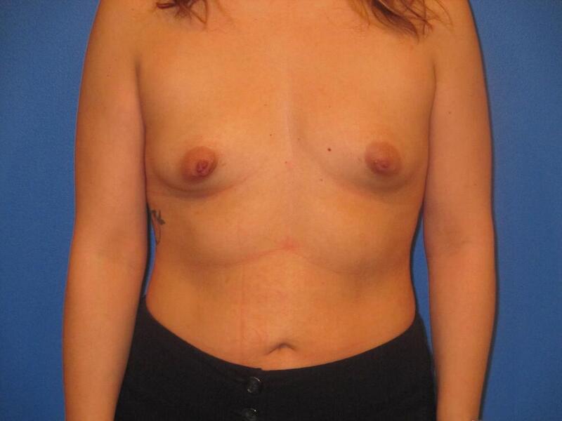 Breast Augmentation Before & After Image