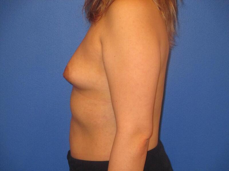 Breast Augmentation Before & After Image