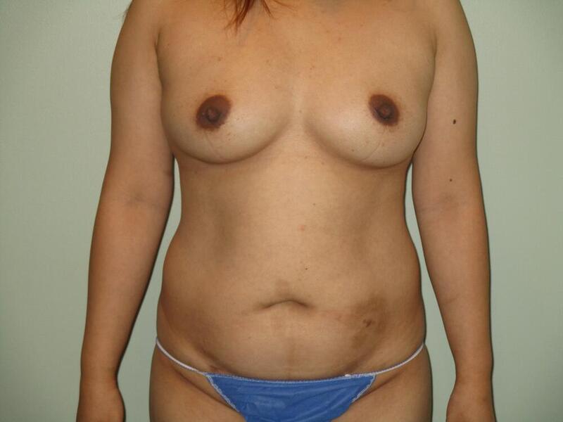 Breast Augmentation Before & After Image