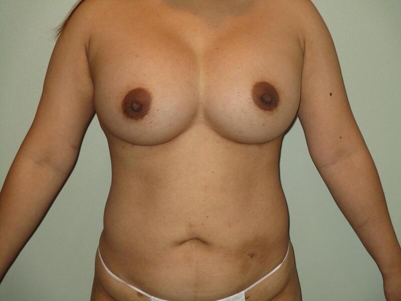 Breast Augmentation Before & After Image