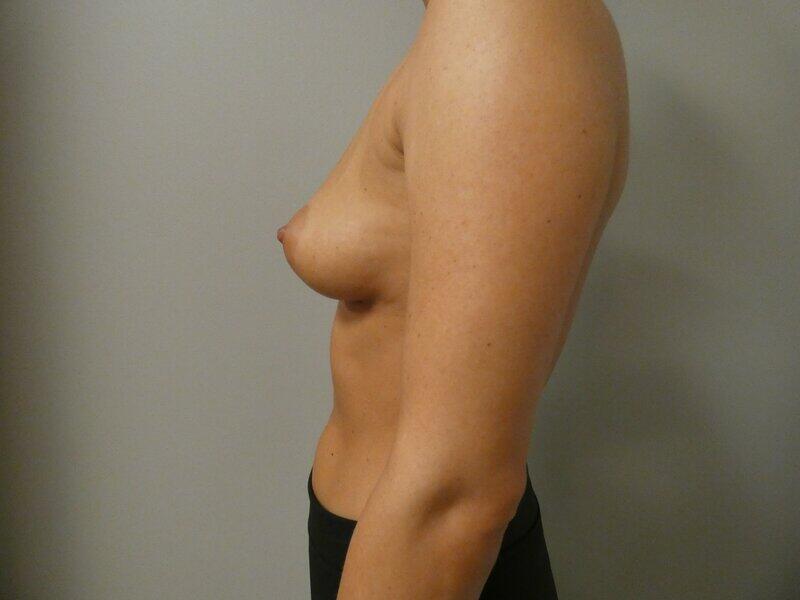 Breast Augmentation Before & After Image