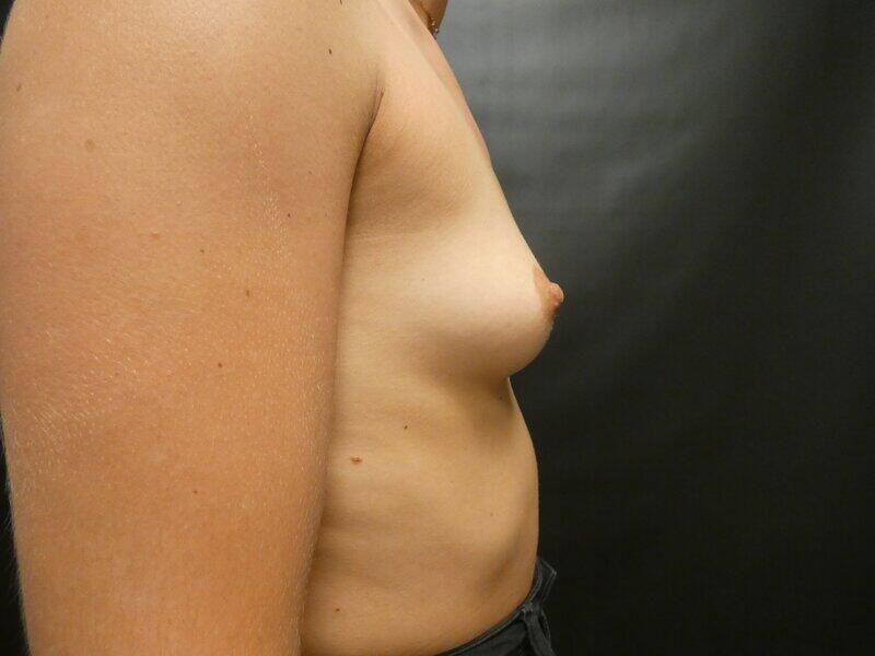 Breast Augmentation Before & After Image