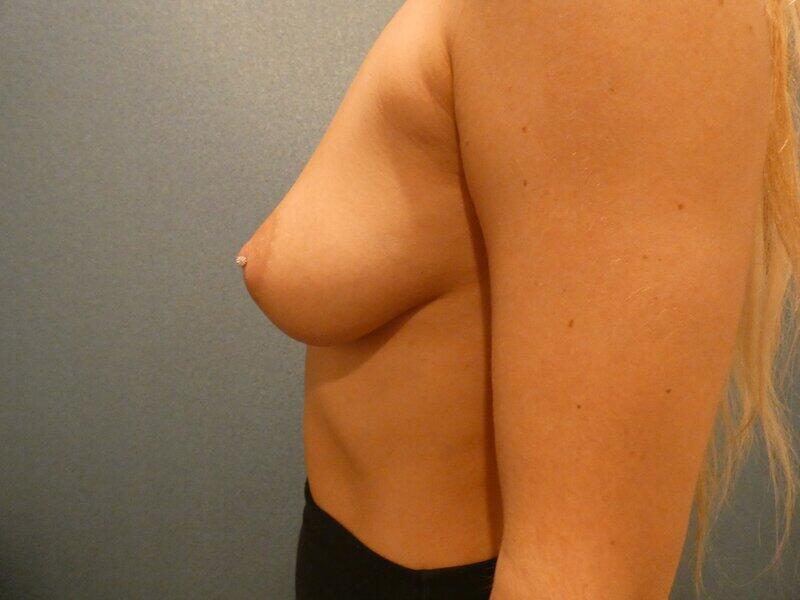 Breast Augmentation Before & After Image