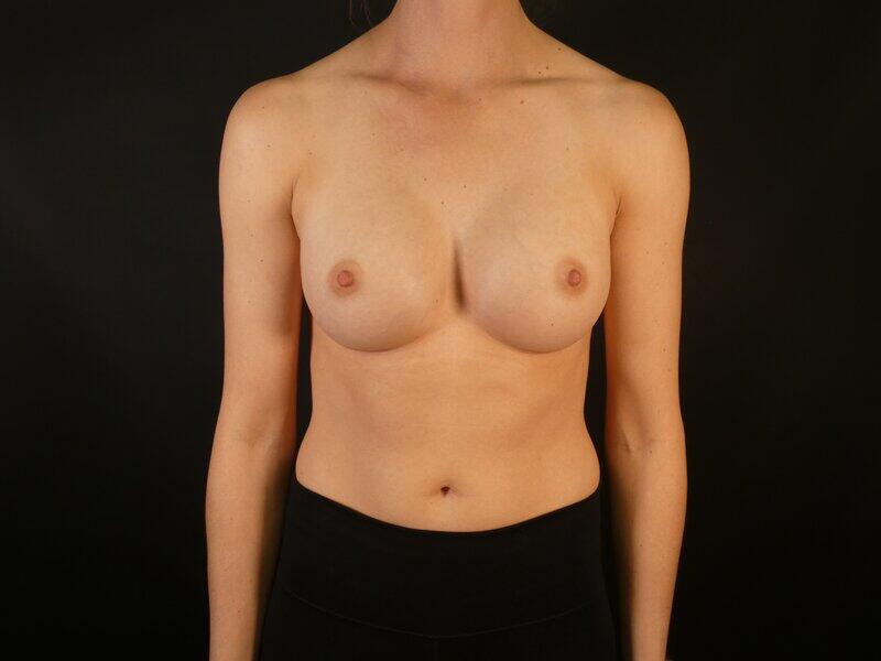 Breast Augmentation Before & After Image