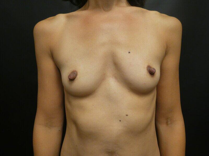 Breast Augmentation Before & After Image